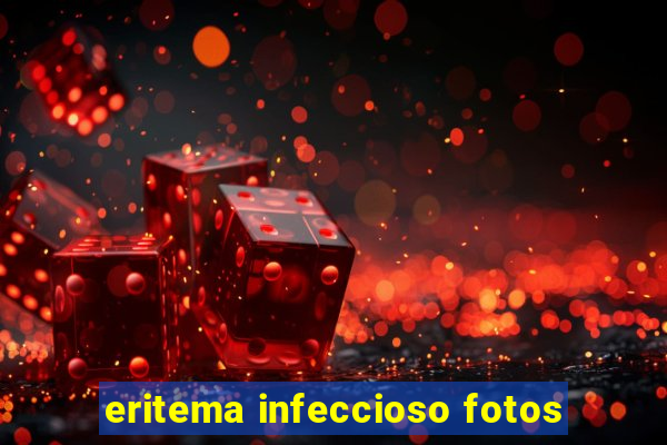 eritema infeccioso fotos